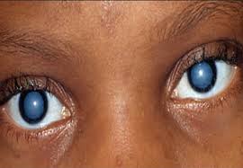Cataract