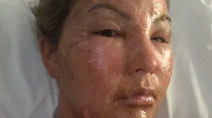 Horror-Woman-Suffers-Serious-Burns-As-Her-Hand-Sanitiser-Explodes