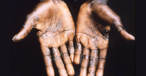 monkeypox